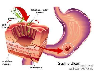 胃溃疡为什么那么难治愈<strong>胃溃疡</strong>，吃什么对胃溃疡痊愈有帮助呢？