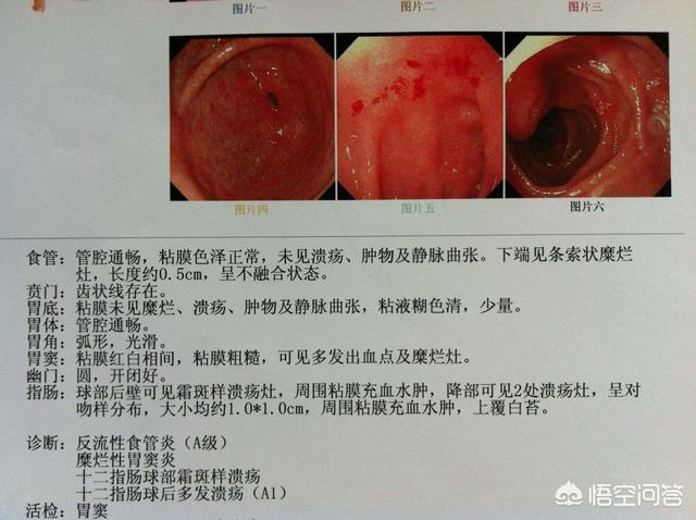 十二脂肠溃疡与肠炎有什么区别<strong>肠炎</strong>？