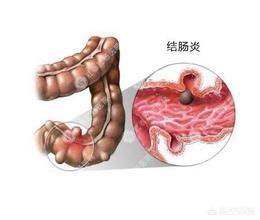 在医院检查出慢性肠炎<strong>肠炎</strong>，有什么好的治疗方法？