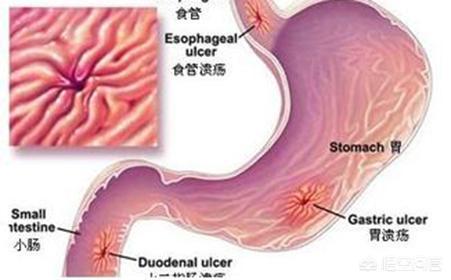 有胃炎<strong>胃炎</strong>，能吃什么肉？