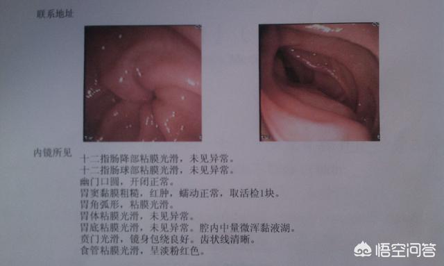 慢性胃炎是什么<strong>胃炎</strong>？有何引起？如何治疗？