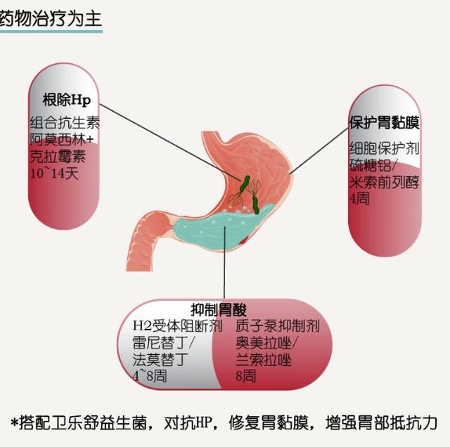 幽门螺杆菌是什么<strong>胃溃疡</strong>？会引起胃病吗？