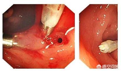 为什么胃溃疡就变成了胃穿孔<strong>胃溃疡</strong>？