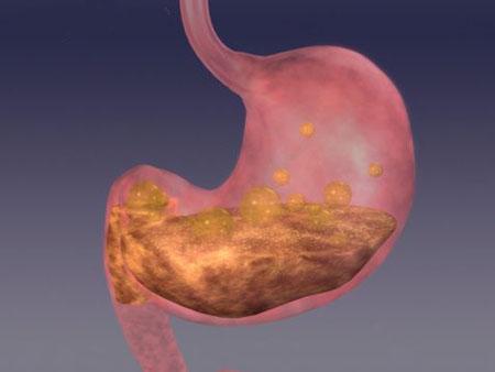 胃炎、胃溃疡是因为幽门螺杆菌吗<strong>胃溃疡</strong>？