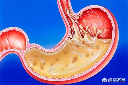 为什么会胃疼、胃酸<strong>胃脘痛</strong>？如何缓解？