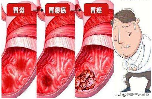 养胃的“冠军”是什么<strong>健胃</strong>？