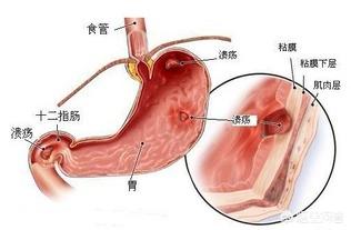 胃溃疡和十二指肠溃疡的区别在哪<strong>十二指肠</strong>，会癌变吗？