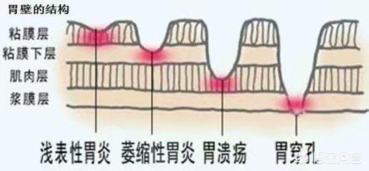 胃不好有什么症状?胃病常见病因及症状是什么?该如何治疗和护理<strong>胃病</strong>？