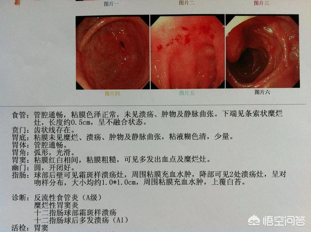 睡醒来胃痛是什么原因<strong>胃脘痛</strong>？