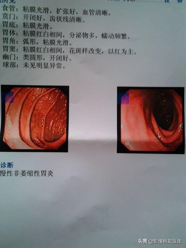 慢性胃炎分为几类<strong>胃炎</strong>？哪种危害更大？哪种会导致胃癌呢？