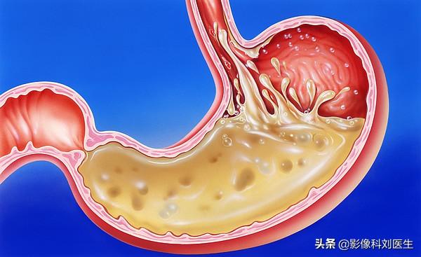 慢性胃炎分为几类<strong>胃炎</strong>？哪种危害更大？哪种会导致胃癌呢？