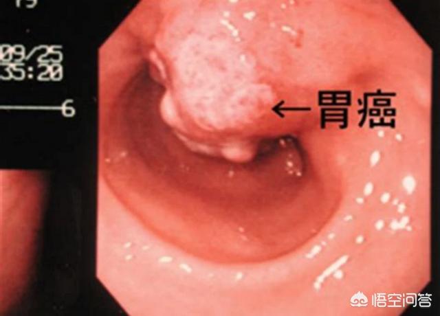 胃病只是觉得胃痛而已吗<strong>胃病</strong>？
