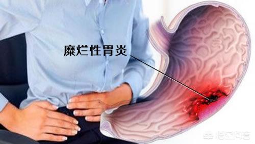 有的人患有浅表性胃炎伴轻度糜烂<strong>胃炎</strong>，并且在饭后出现了腹部胀痛的情况，你觉得应该怎么办？