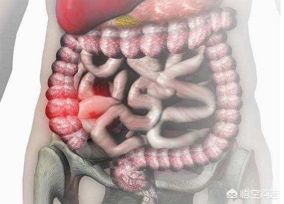 克罗恩病有哪些症状<strong>肠道</strong>？有什么治疗的方法？