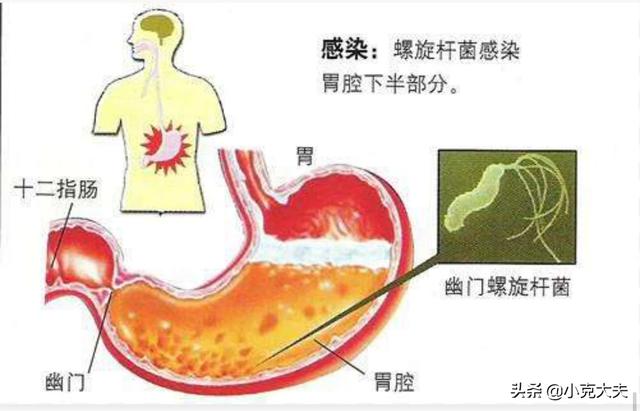 糜烂性胃炎十二指肠炎吃什么药最好<strong>十二指肠</strong>？