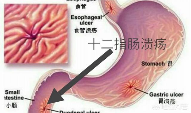 查出十二指肠溃疡<strong>十二指肠</strong>，服药二个月，为什么还有黑便？