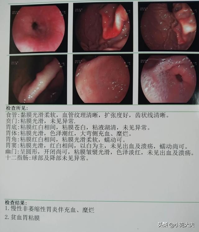 红斑渗出性胃炎十二指肠球炎十多年了<strong>十二指肠</strong>，不吃药能自愈吗？