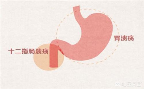 胃十二指肠球部多发息肉、非萎缩性胃炎伴糜烂严重吗？