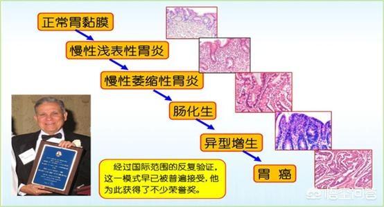 胃十二指肠球部多发息肉、非萎缩性胃炎伴糜烂严重吗<strong>十二指肠</strong>？