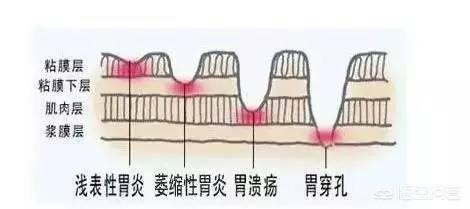 浅表性胃炎是怎么造成的<strong>胃病</strong>？