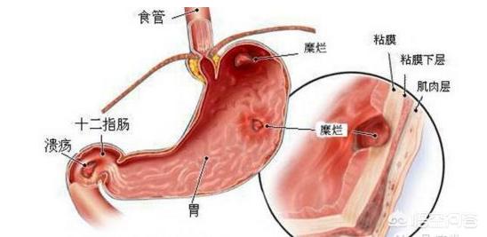 有慢性胃炎<strong>健胃</strong>，吃什么养胃？