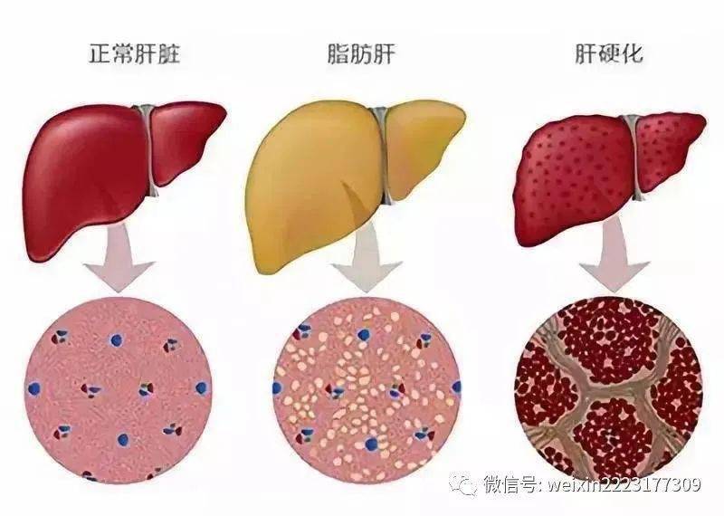 肝脏功能下降怎么办肝脏功能