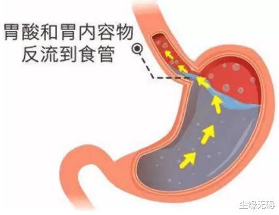 反流性食管炎,反流性食管炎b级严重吗