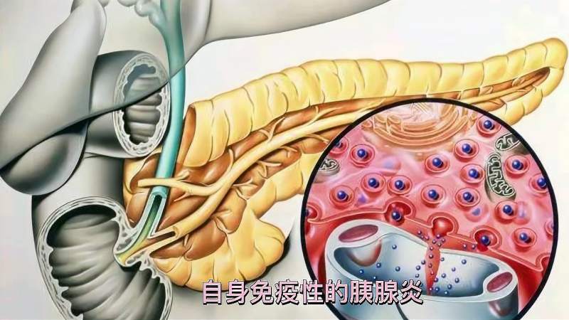 坏死性胰腺炎是什么引起的,坏死性胰腺炎