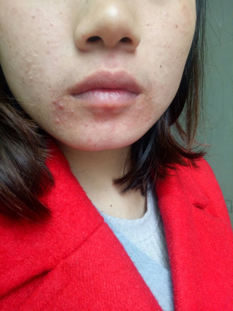下巴长痘痘反反复复是什么原因下巴长痘