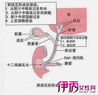 胆管结石,胆管结石怎么能排出来了