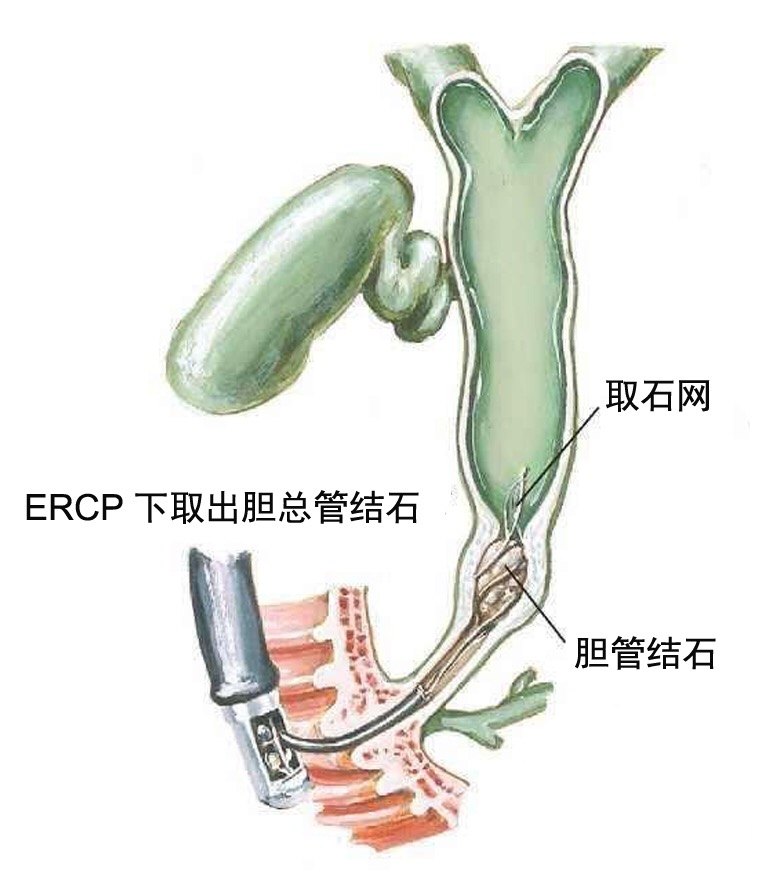 胆管结石,胆管结石怎么能排出来了