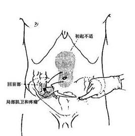 阑尾炎症状表现有哪些,阑尾炎症状表现有哪些会拉肚子吗