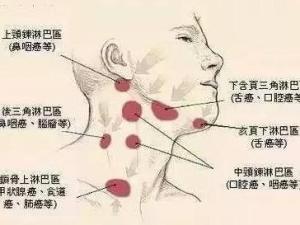慢性淋巴结炎会癌变吗,慢性淋巴结炎