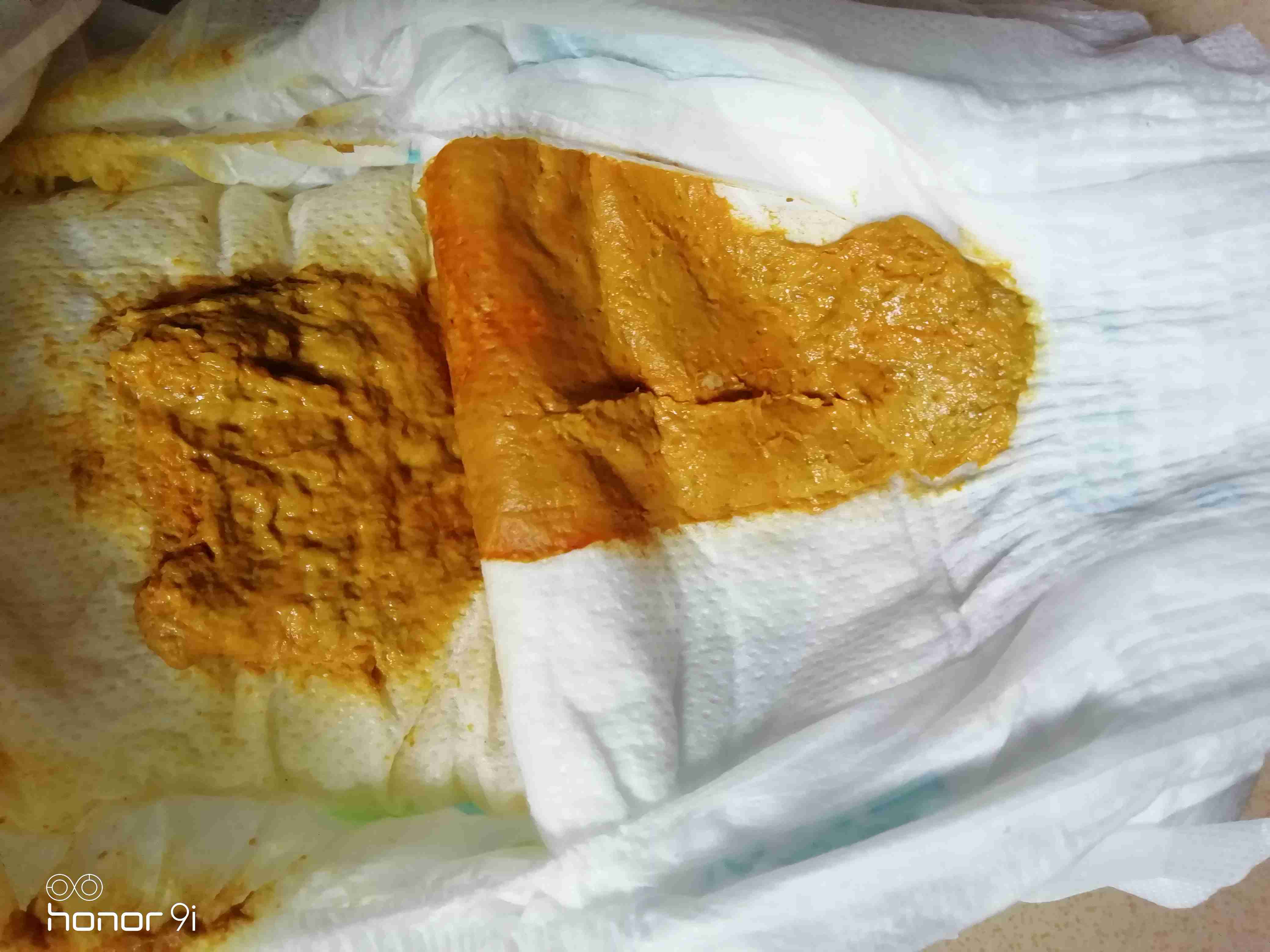 一天大便三四次正常吗一天大便三四次,总感觉排不尽