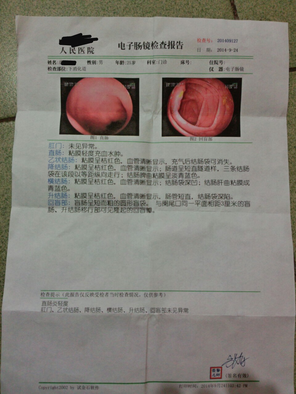 肛门口有个肉球突出是怎么回事,6种症状需做肠镜检查