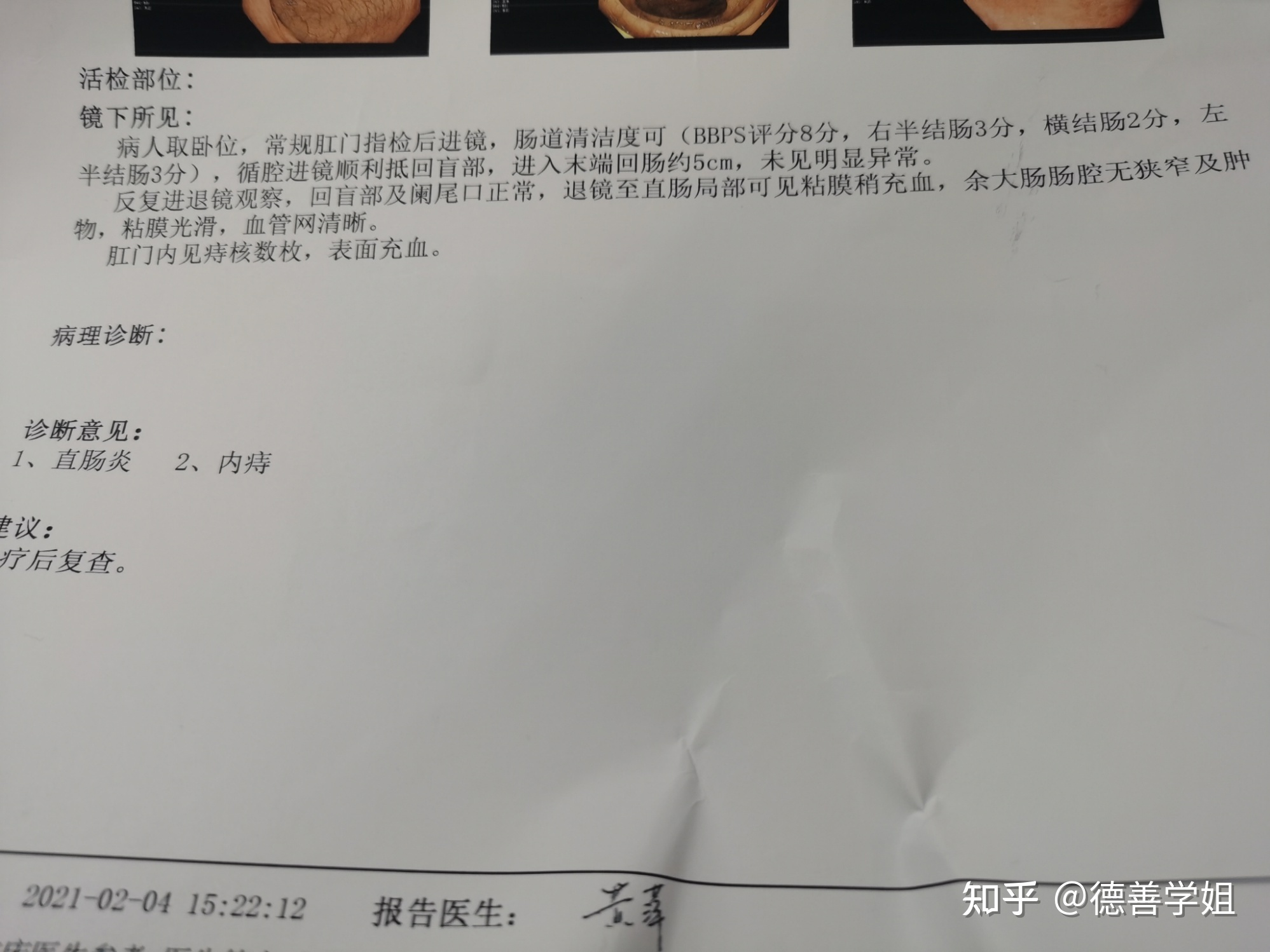 肛门口有个肉球突出是怎么回事,6种症状需做肠镜检查