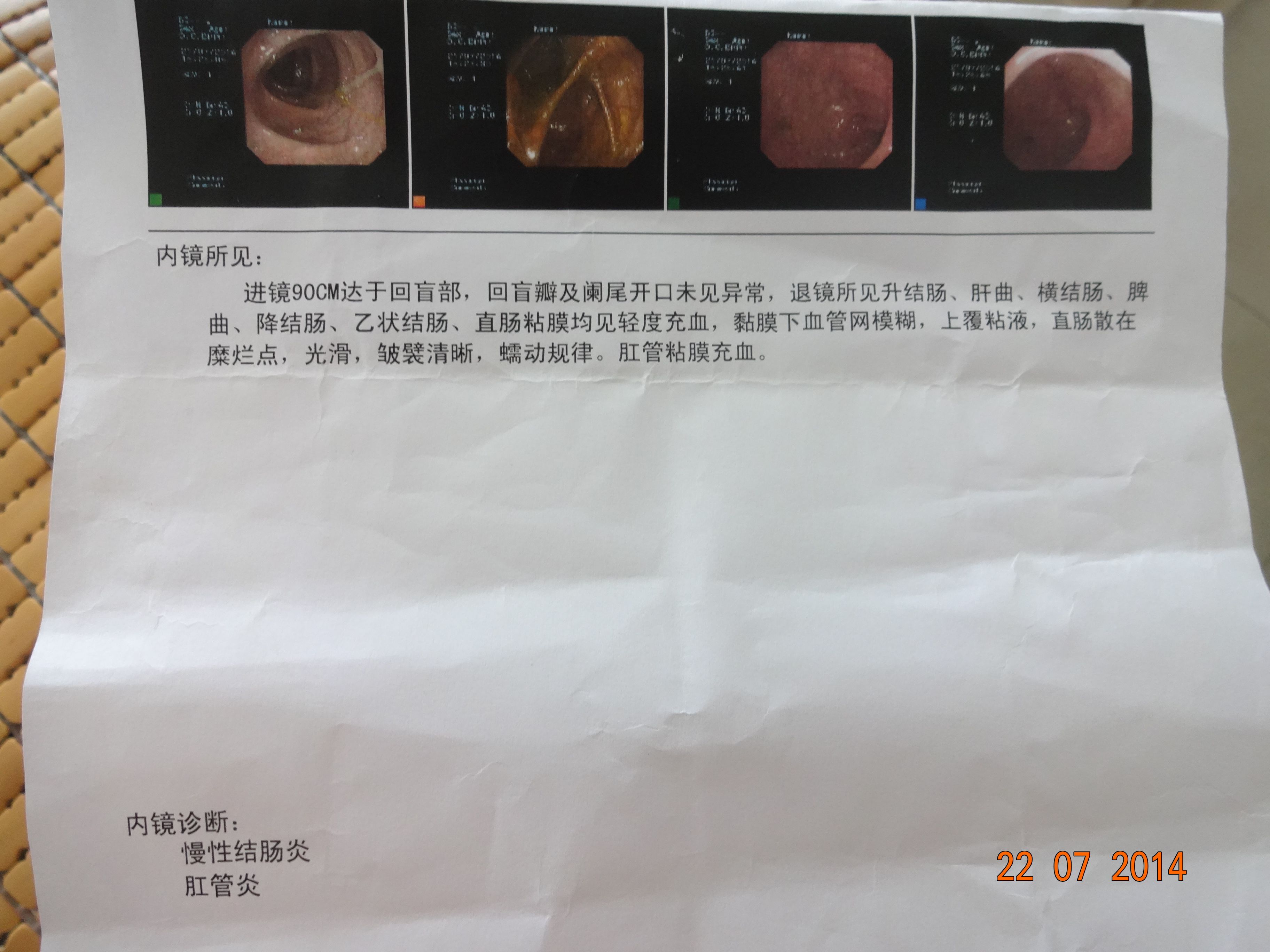 慢性肠炎吃什么药治疗效果好慢性肠炎