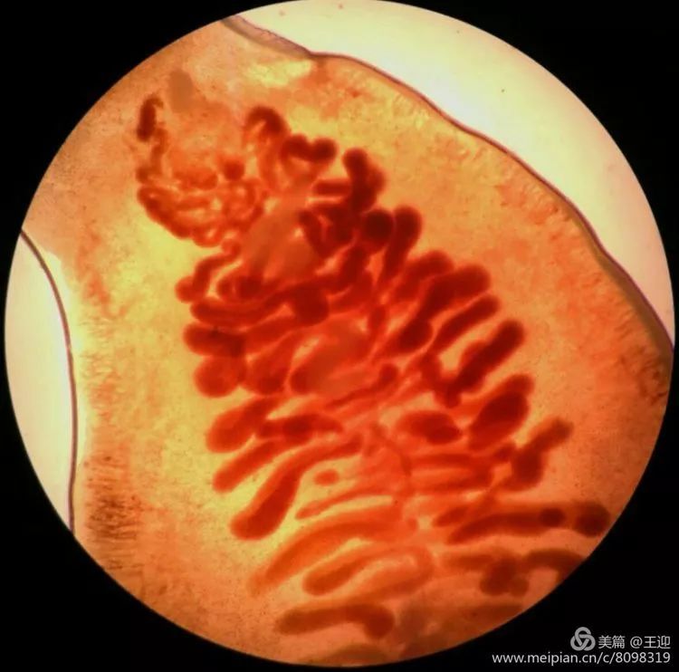 肝吸虫病怎么查出来啊?肝吸虫病