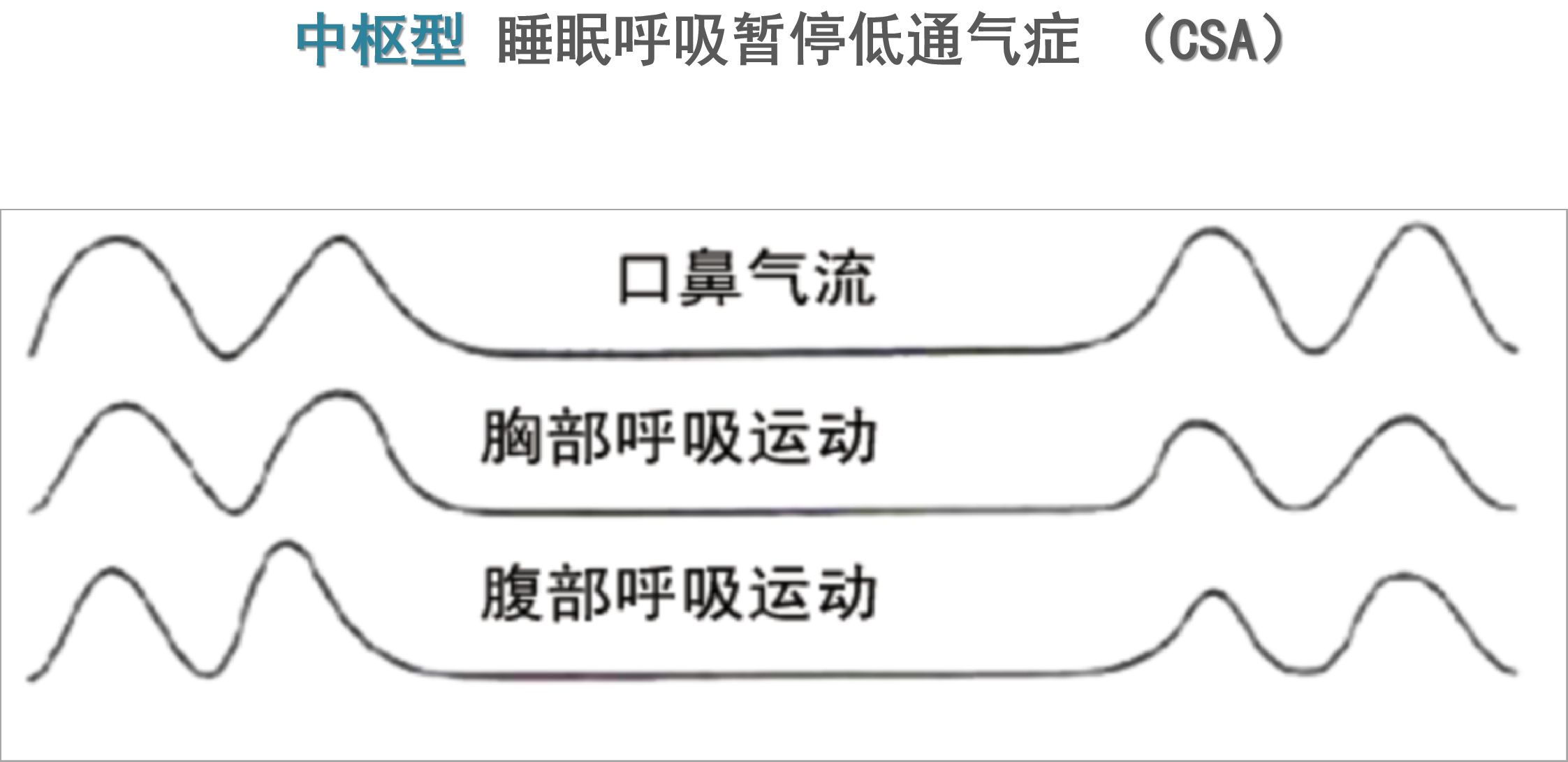 关于睡眠呼吸暂停综合症严重程度分级的信息