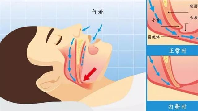 睡觉打鼾是什么原因引起的,睡觉打鼾是什么原因引起的吃什么药