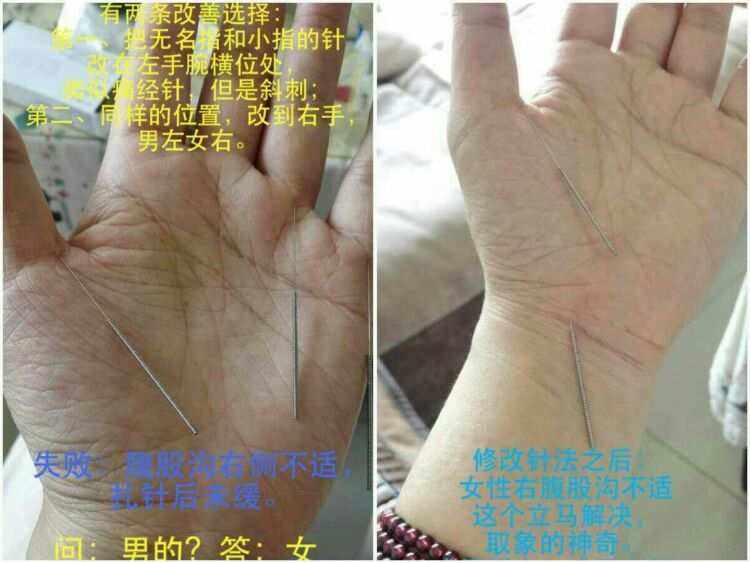 道家针法阴阳九针,道家针法阴阳九针视频
