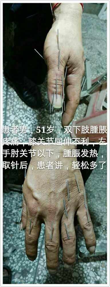 道家针法阴阳九针,道家针法阴阳九针视频