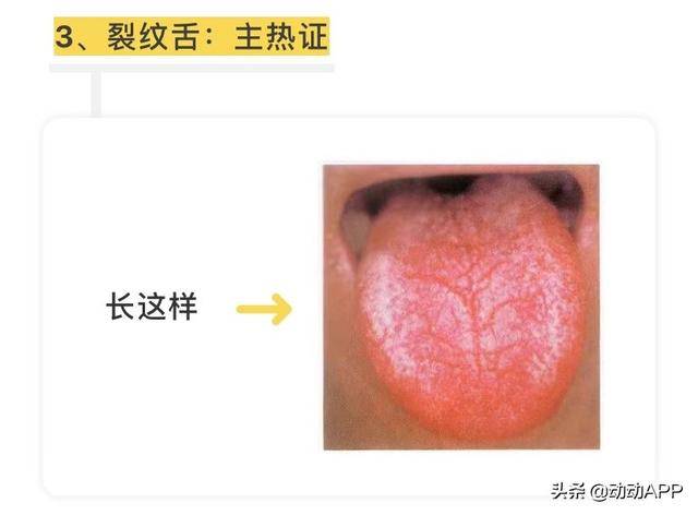 地图舌地图舌是缺乏哪种维生素