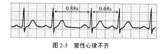 什么是窦性心律不齐什么是窦性心律不齐是什么意思