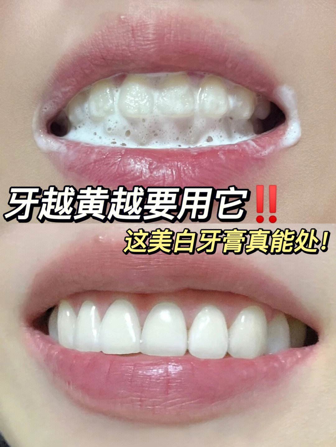 牙垢,牙垢怎么清理