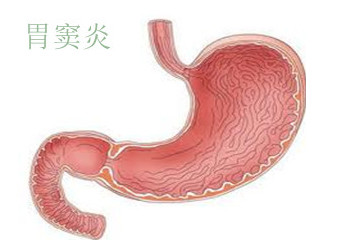 胃窦炎症状胃窦炎是什么症状严重吗