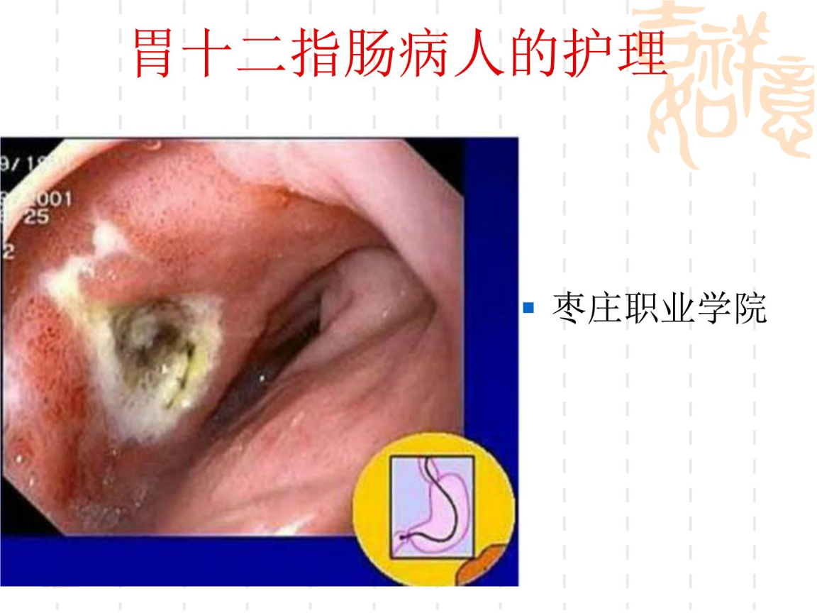 十二指肠溃疡的症状及表现,十二指肠溃疡的症状