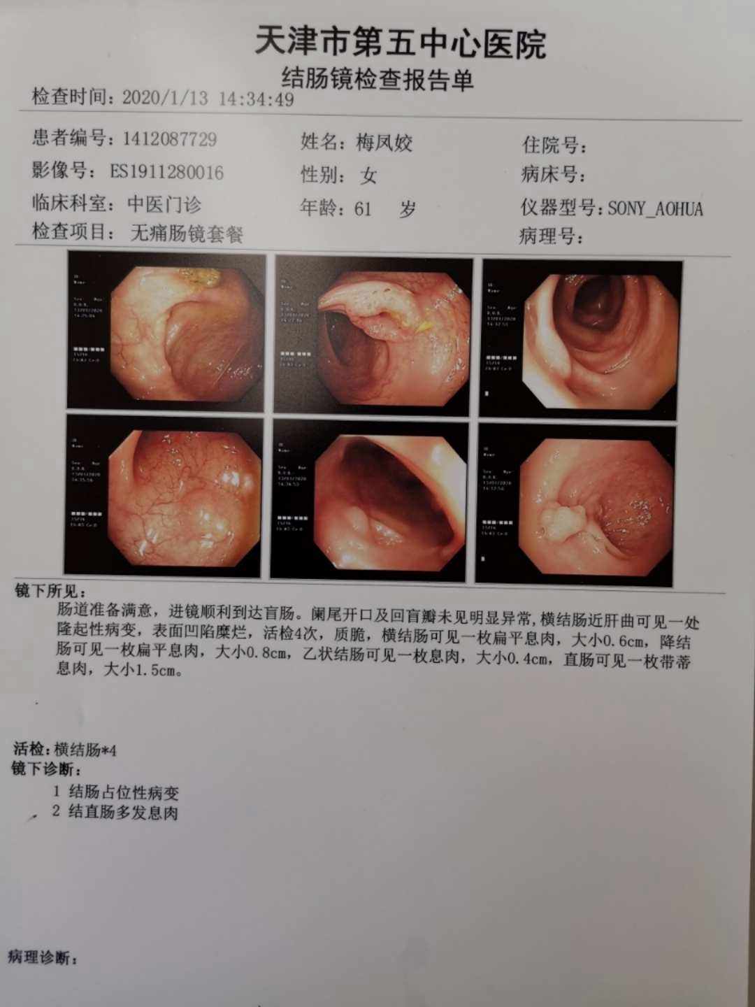 结肠癌结肠癌晚期最怕三个征兆