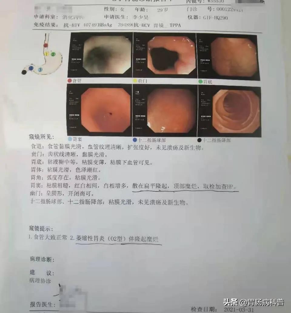 浅表性萎缩性胃炎的症状及治疗萎缩性胃炎的症状及治疗