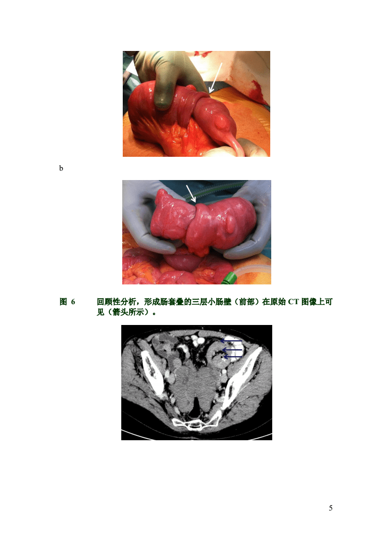 肠套叠,肠套叠是什么病严重吗